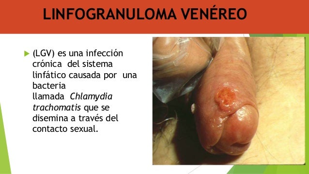 linfogranuloma venereo
